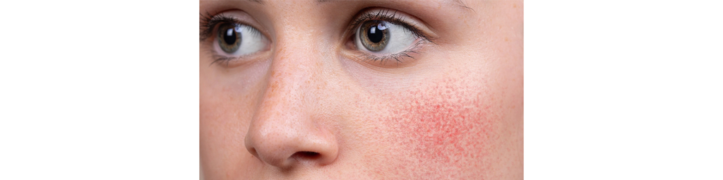 Podráždená a začervenaná pokožka v oblasti tváre - ružovka/rosacea.